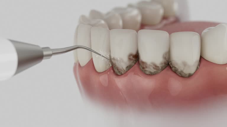 Trusted Wisdom Tooth Removal service in Chisago City, MN - Dentist Open Now